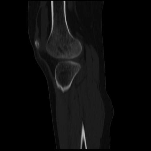 File:ACL avulsion fracture (Radiopaedia 33833-34994 Sagittal bone window 14).jpg