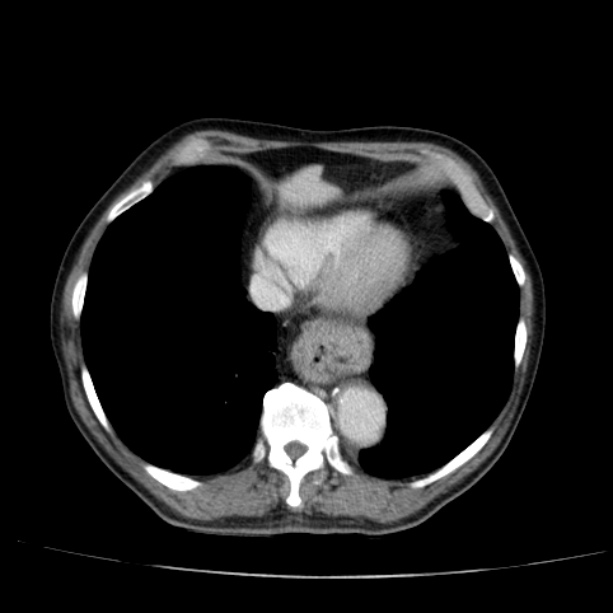 Abdominal aortic aneurysm (Radiopaedia 29248-29660 Axial C+ portal venous phase 7).jpg