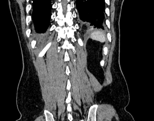 Abdominal aortic aneurysm (Radiopaedia 67117-76452 Coronal C+ arterial phase 99).jpg