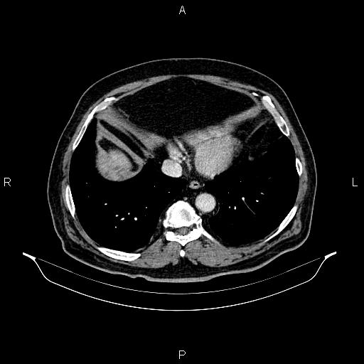 Abdominal aortic aneurysm (Radiopaedia 83094-97462 Axial renal cortical phase 58).jpg