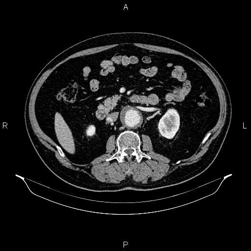 Abdominal aortic aneurysm (Radiopaedia 83094-97462 Axial renal cortical phase 93).jpg