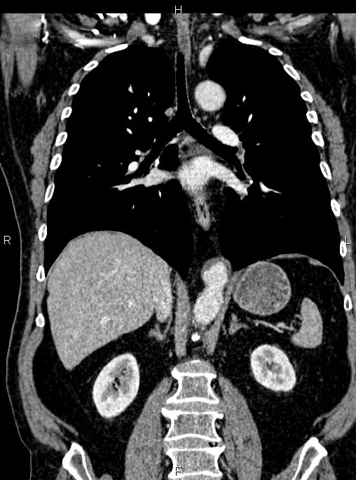 Abdominal aortic aneurysm (Radiopaedia 83094-97462 Coronal renal cortical phase 56).jpg