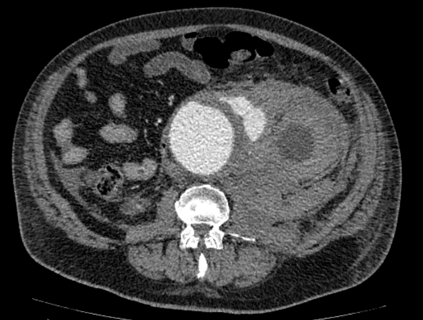 Abdominal aortic aneurysm rupture (Radiopaedia 54179-60362 Axial C+ portal venous phase 19).jpg