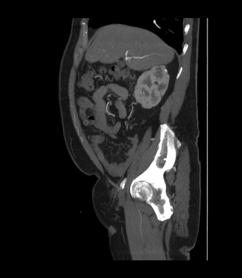 Abdominal aortic aneurysm with thrombus fissuration (Radiopaedia 46218-50618 Sagittal C+ arterial phase 17).jpg