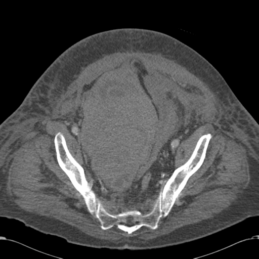 File:Abdominal hematoma (Radiopaedia 33614-34715 Axial C+ portal venous phase 109).png