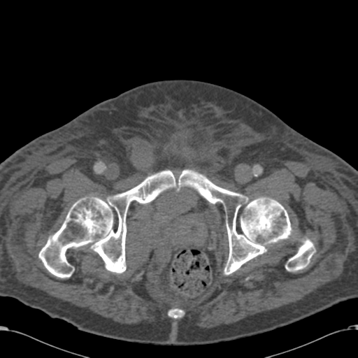 Abdominal hematoma (Radiopaedia 33614-34715 Axial C+ portal venous phase 129).png