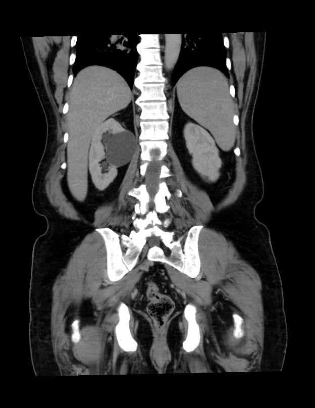 Abdominal lymphoma - with sandwich sign (Radiopaedia 53486-59492 C+ portal venous phase 15).jpg