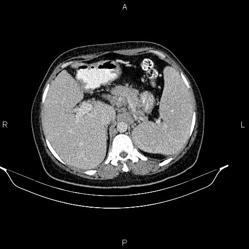 File:Abdominal lymphoma with sandwich sign (Radiopaedia 84378-99704 Axial C+ portal venous phase 14).jpg