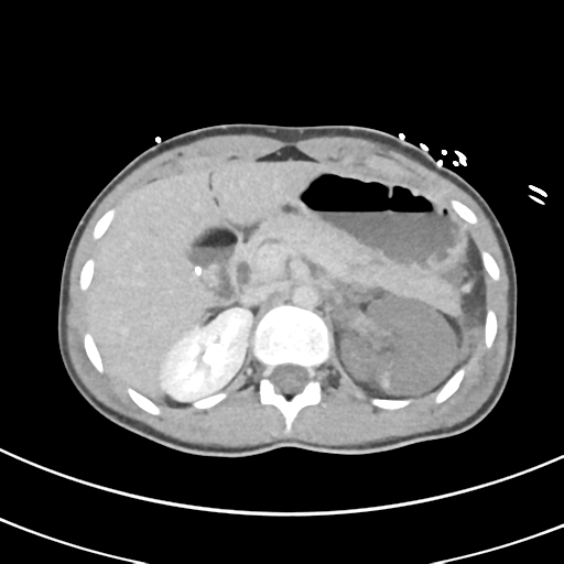 File:Abdominal multi-trauma - devascularised kidney and liver, spleen and pancreatic lacerations (Radiopaedia 34984-36486 Axial C+ delayed 23).png