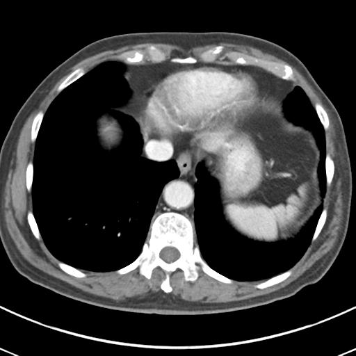 Abdominal wall metastasis from colorectal carcinoma (Radiopaedia 31016-31717 Axial C+ portal venous phase 11).jpg