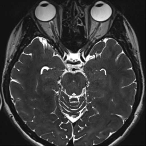 Abducens nerve palsy (Radiopaedia 51069-56648 Axial T2 fat sat 59).png