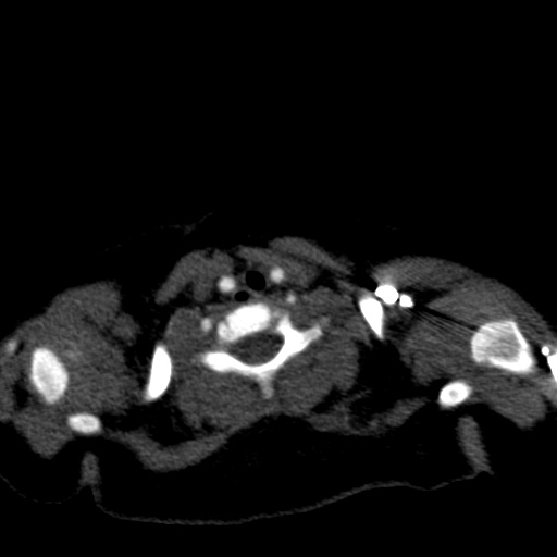 Aberrant left pulmonary artery (pulmonary sling) (Radiopaedia 42323-45435 Axial C+ CTPA 1).jpg