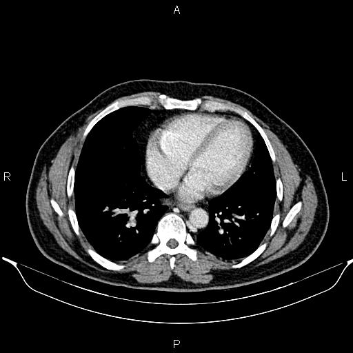 File:Aberrant right subclavian artery (Radiopaedia 87093-103354 Axial With contrast 75).jpg
