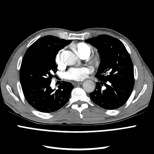 File:Accessory left horizontal fissure with lingular pneumonia (Radiopaedia 53763-59843 Axial C+ CTPA 52).jpg