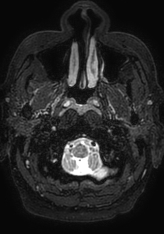 Accessory middle cerebral artery (Radiopaedia 73114-83828 Axial T2 220).jpg