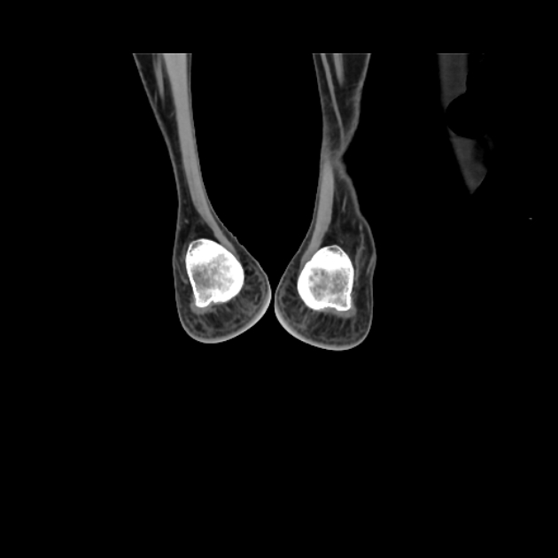 Accessory soleus muscle (Radiopaedia 61069-68943 Coronal non-contrast 68).jpg
