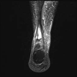 File:Achilles tendon tear (Radiopaedia 77615-89819 Coronal STIR 23).jpg