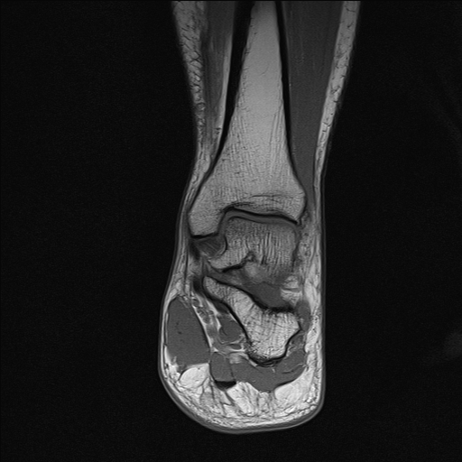 File:Achilles tendon tear (Radiopaedia 77615-89819 Coronal T1 16).jpg