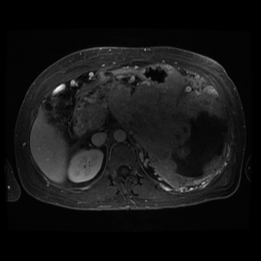Acinar cell carcinoma of the pancreas (Radiopaedia 75442-86668 D 64).jpg