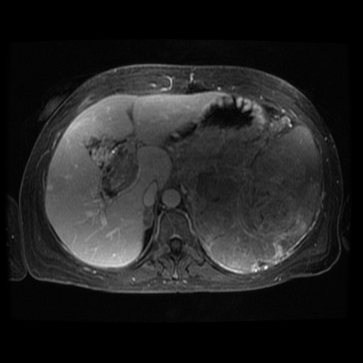 Acinar cell carcinoma of the pancreas (Radiopaedia 75442-86668 D 94).jpg