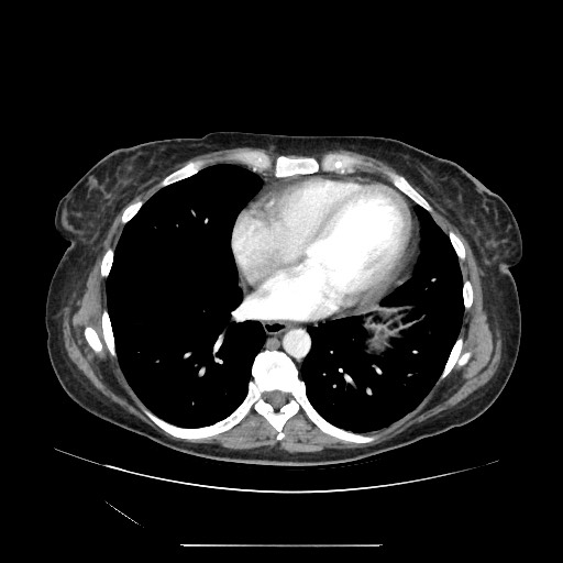 Acinar cell carcinoma of the pancreas (Radiopaedia 75442-86669 Axial C+ portal venous phase 3).jpg