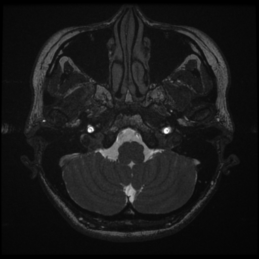 Acoustic neuroma (Radiopaedia 34049-35283 Axial 22).png
