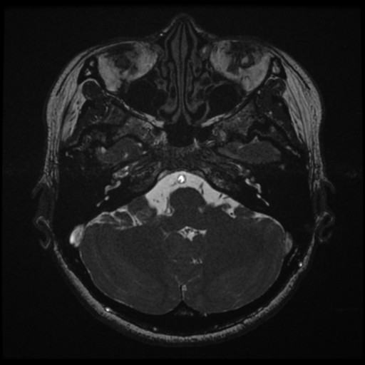Acoustic neuroma (Radiopaedia 34049-35283 Axial 44).png