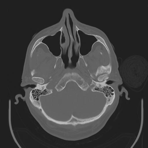 File:Acoustic schwannoma (Radiopaedia 29488-29982 AXIAL BONE THICK non-contrast 8).jpg