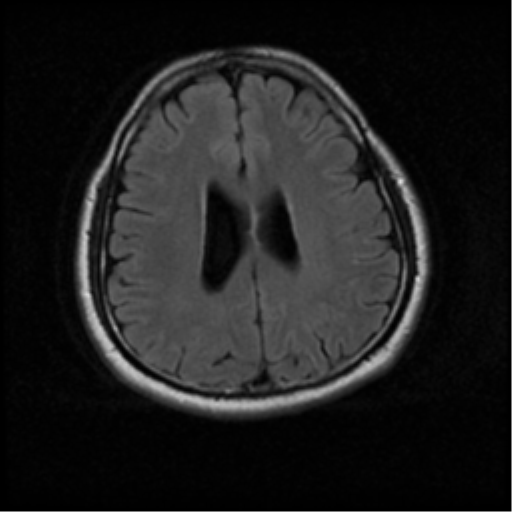 File:Acoustic schwannoma (Radiopaedia 33045-34060 Axial FLAIR 15).png