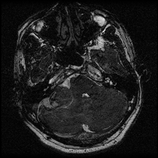 File:Acoustic schwannoma (Radiopaedia 39170-41387 Axial FIESTA 61).png