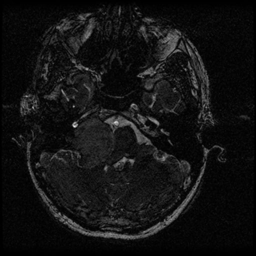 Acoustic schwannoma - eroding petrous apex (Radiopaedia 39674-42004 Axial T2 24).png