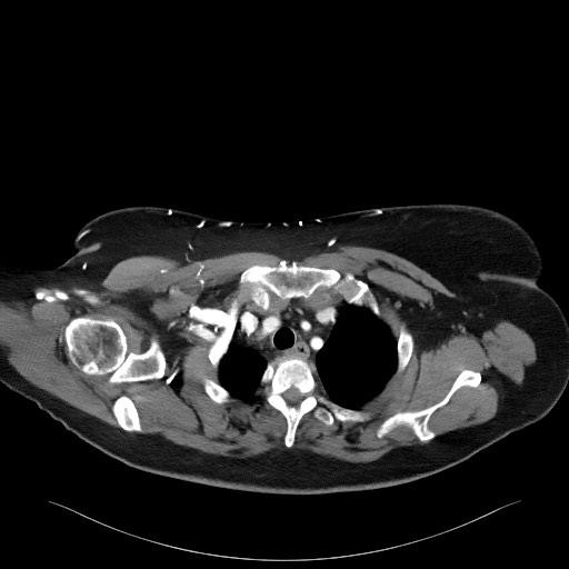 Acromioclavicular joint cyst (Radiopaedia 58455-65610 Axial C+ arterial phase 28).jpg