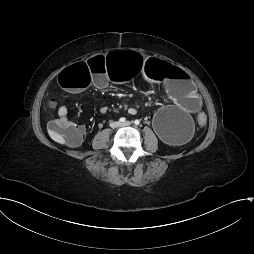 Active Crohn disease (Radiopaedia 59394-66750 Axial C+ portal venous phase 43).jpg
