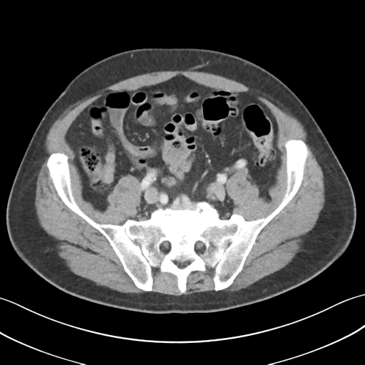 File:Active diverticular hemorrhage (Radiopaedia 39415-41725 Axial C+ portal venous phase 49).png