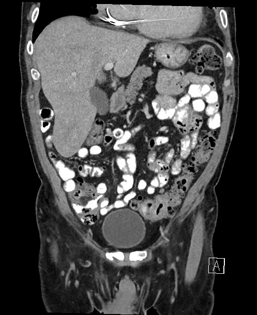 Active lower gastrointestinal bleeding - diverticular (Radiopaedia 61203-69106 Coronal C+ portal venous phase 48).jpg
