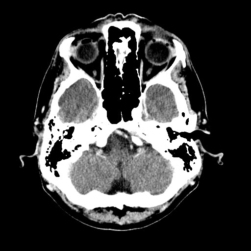 File:Active neurocysticercosis before and after therapy (Radiopaedia 71710-82099 Axial C+ delayed 84).jpg