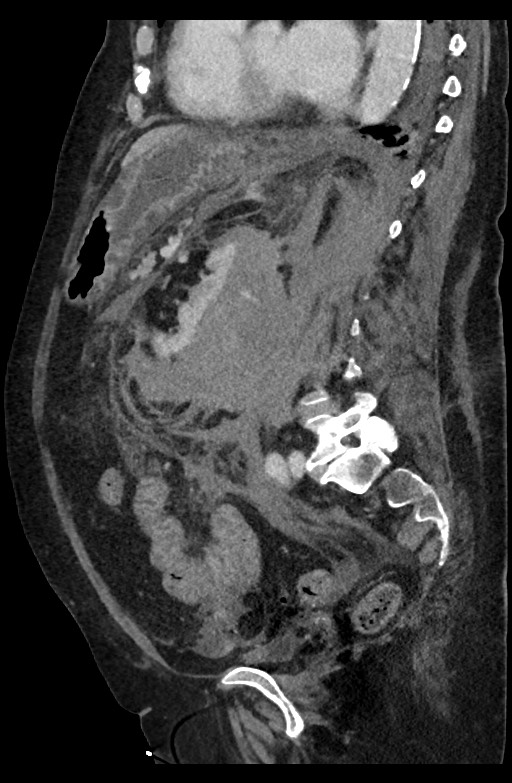 Active renal extravasation with large subcapsular and retroperitoneal hemorrhage (Radiopaedia 60975-68796 Sagittal C+ portal venous phase 101).jpg