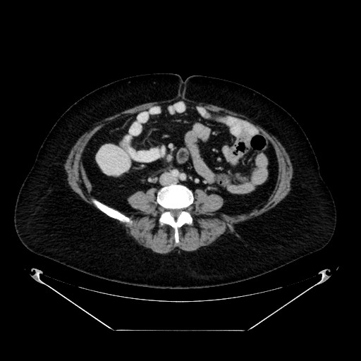 File:Acute appendicitis, heterotaxy syndrome (Radiopaedia 66884-76202 Axial 4).jpg
