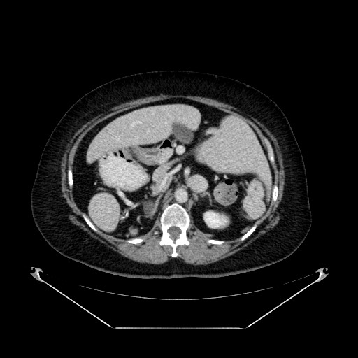 File:Acute appendicitis, heterotaxy syndrome (Radiopaedia 66884-76202 Axial 69).jpg