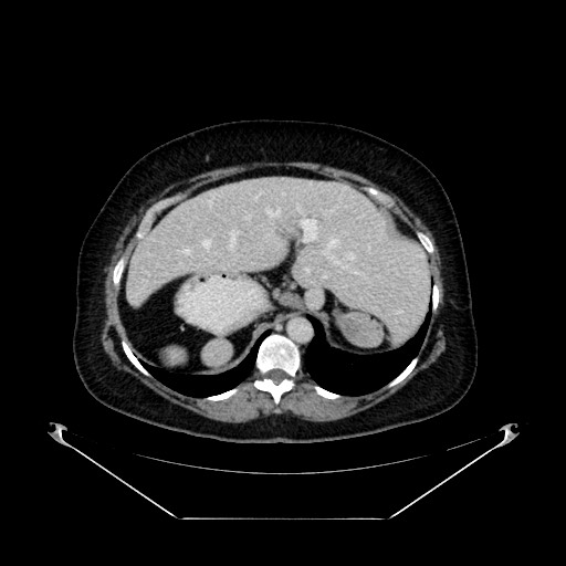 Acute appendicitis, heterotaxy syndrome (Radiopaedia 66884-76202 Axial C+ portal venous phase 29).jpg