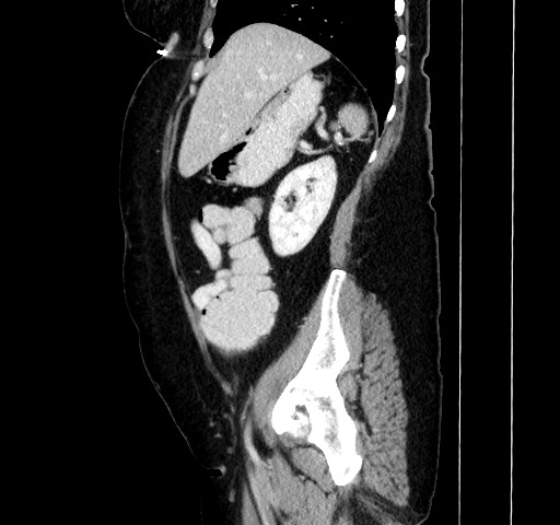 Acute appendicitis, heterotaxy syndrome (Radiopaedia 66884-76202 Sagittal C+ portal venous phase 44).jpg