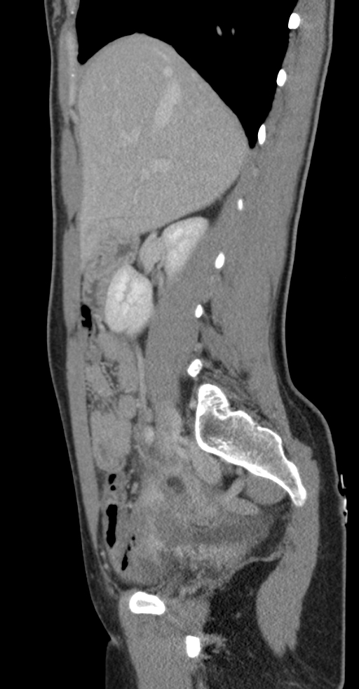 Acute appendicitis (Radiopaedia 62608-70901 Sagittal C+ portal venous phase 35).jpg