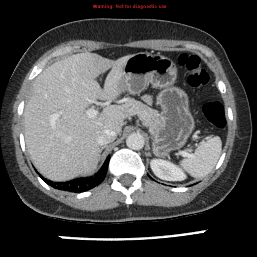 File:Acute appendicitis (Radiopaedia 7966-8812 C+ portal venous phase 5).jpg
