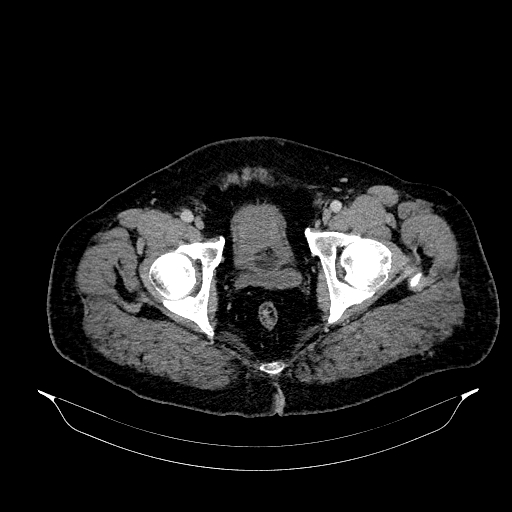 Acute appendicitis (Radiopaedia 79950-93224 Axial C+ portal venous phase 96).jpg