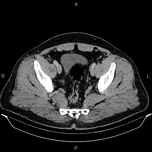 Acute appendicitis (Radiopaedia 84780-100240 Axial C+ portal venous phase 94).jpg
