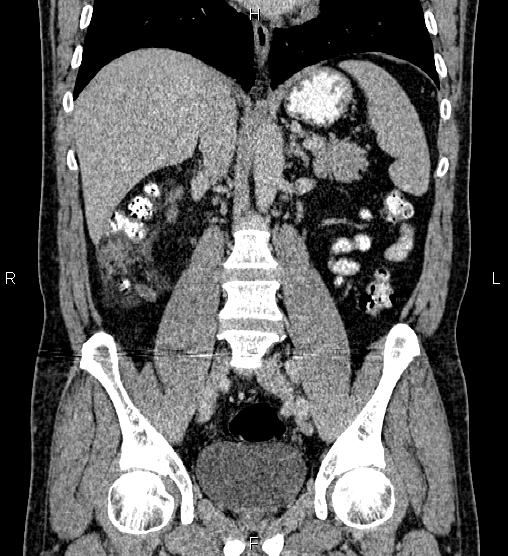 Acute appendicitis (Radiopaedia 84780-100240 Coronal C+ portal venous phase 46).jpg