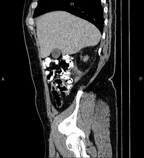 Acute appendicitis (Radiopaedia 84780-100240 Sagittal C+ portal venous phase 18).jpg