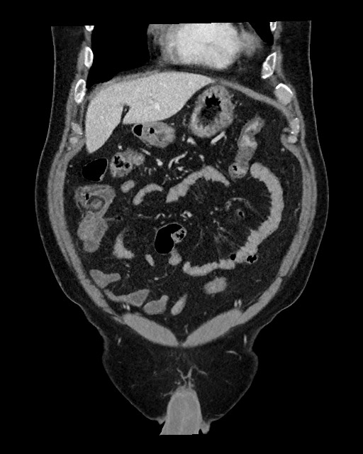 Acute appendicitis - large appendicoliths (Radiopaedia 61805-69820 Coronal C+ portal venous phase 37).jpg