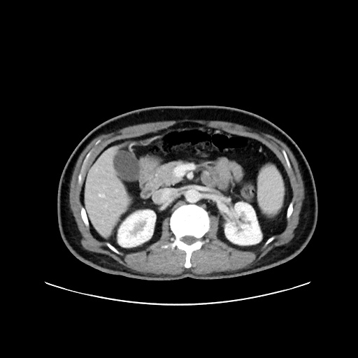 Acute appendicitis and COVID 19 pneumonia (Radiopaedia 76604-88380 Axial C+ portal venous phase 29).jpg