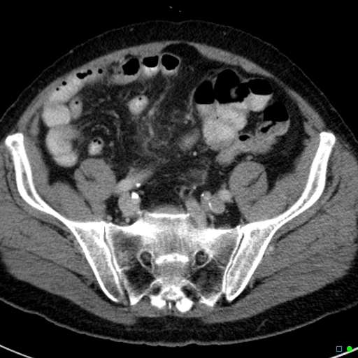 File:Acute appendicitis arising from a malrotated cecum (Radiopaedia 19970-19997 Axial C+ portal venous phase 34).jpg